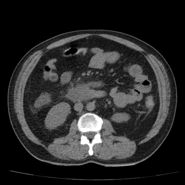 Acute pancreatitis (Radiopaedia 26663-26813 Axial non-contrast 52).jpg