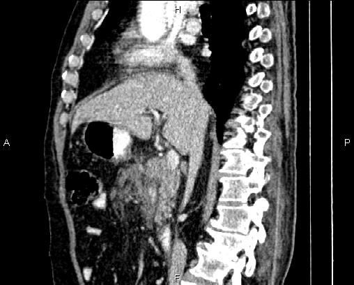 Acute pancreatitis (Radiopaedia 85146-100701 Sagittal C+ portal venous phase 40).jpg