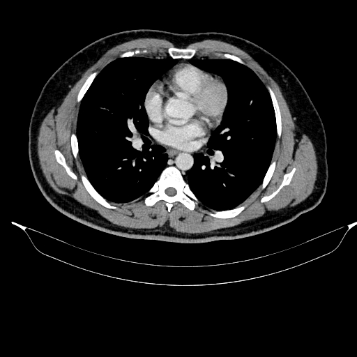 Acute pancreatitis (Radiopaedia 87428-103757 Axial C+ portal venous phase 7).jpg