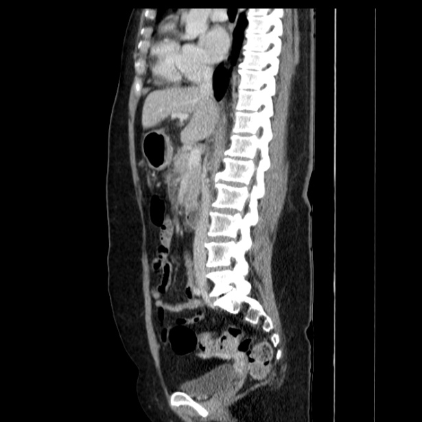 Acute pancreatitis - Balthazar C (Radiopaedia 26569-26714 Sagittal C+ portal venous phase 33).jpg