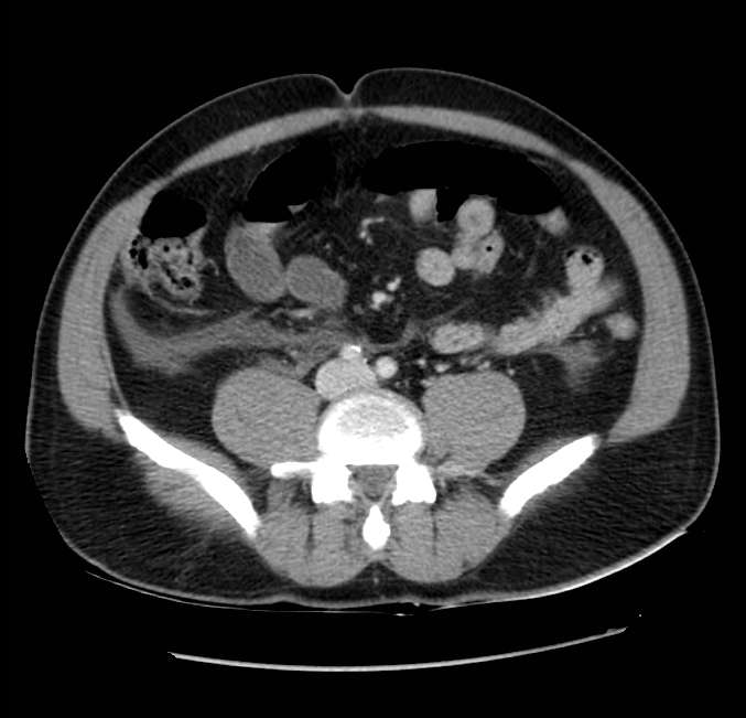 Acute pancreatitis - Balthazar E (Radiopaedia 23080-23110 Axial C+ portal venous phase 45).jpg