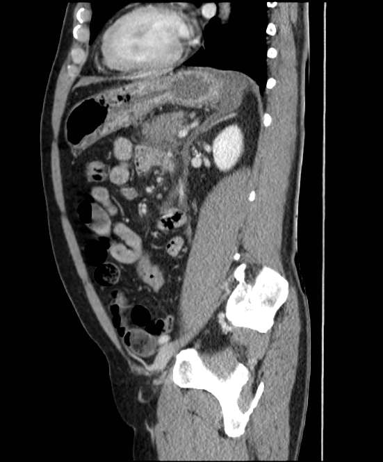 Acute pancreatitis - Balthazar E (Radiopaedia 23080-23110 Sagittal C+ portal venous phase 65).jpg