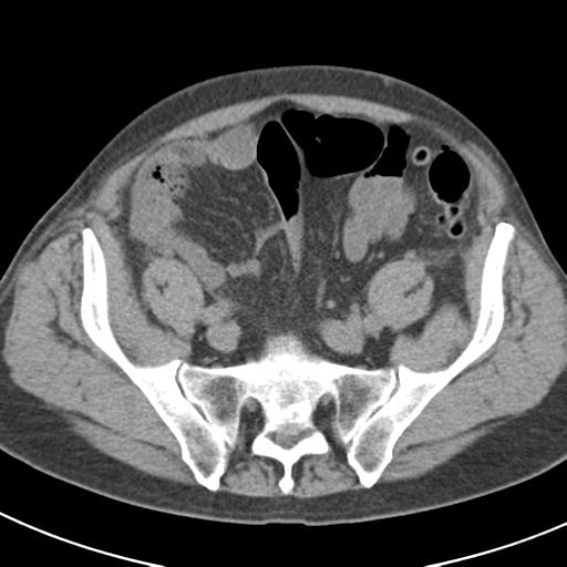 File:Acute pancreatitis and walled-off necrosis (Radiopaedia 29888-30403 Axial non-contrast 58).jpg