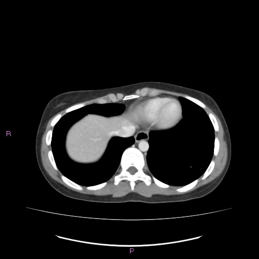 Acute pancreatitis secondary to stone at minor papilla and pancreatic divisum (Radiopaedia 76570-88333 Axial C+ portal venous phase 9).jpg