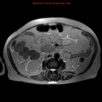File:Acute pancreatitis with incidental pancreatic lipoma (Radiopaedia 10190-10732 Axial T2 1).jpg