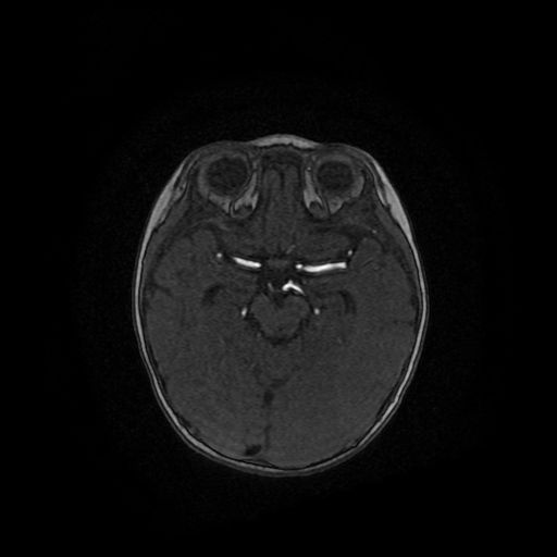 Acute phase of hemiconvulsion-hemiplegia epilepsy syndrome (Radiopaedia 29309-29745 Axial TOF angiography 80).jpg