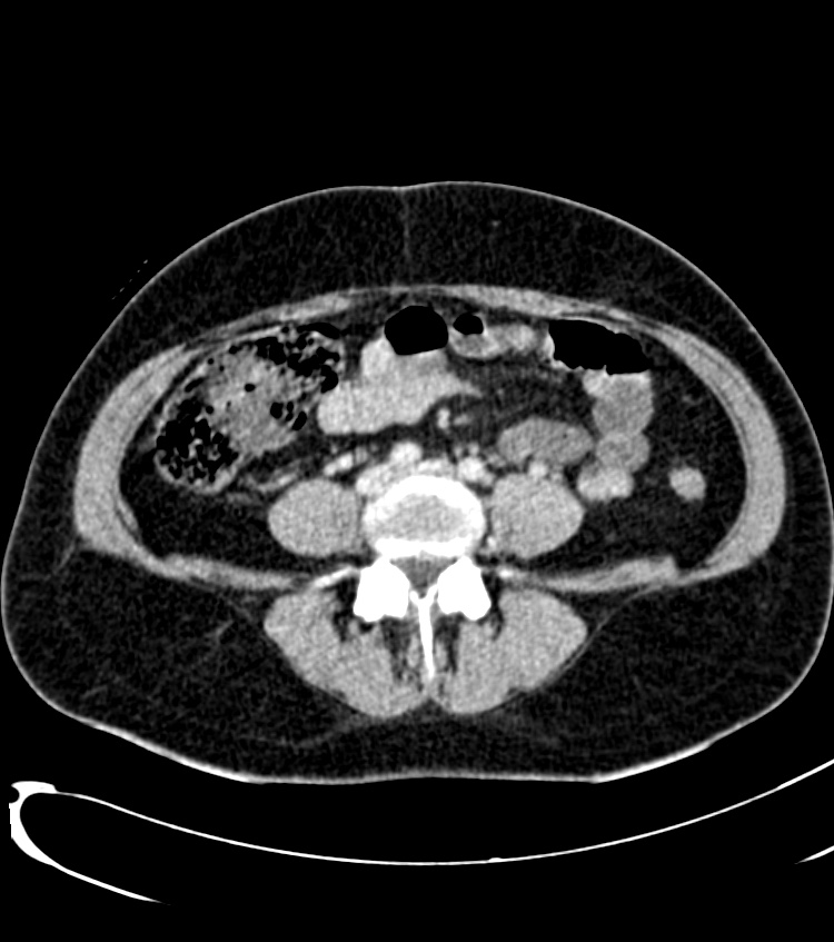 Acute pyelonephritis (Radiopaedia 40264-42816 Axial C+ portal venous phase 47).jpg