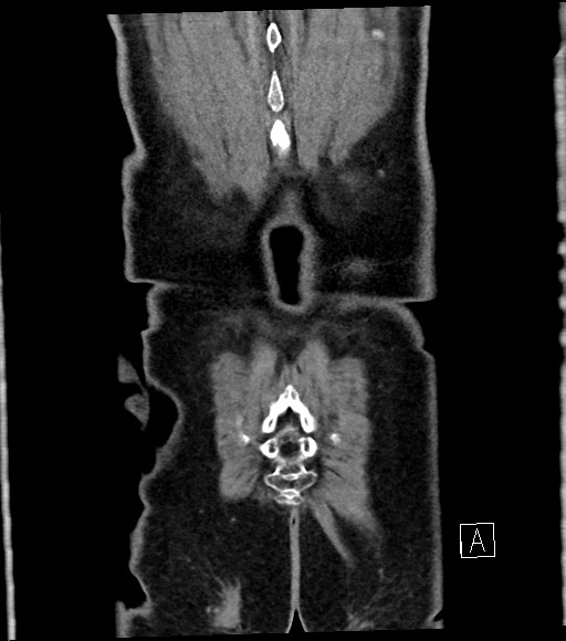 Acute renal infarction (Radiopaedia 59375-66736 Coronal C+ portal venous phase 60).jpg