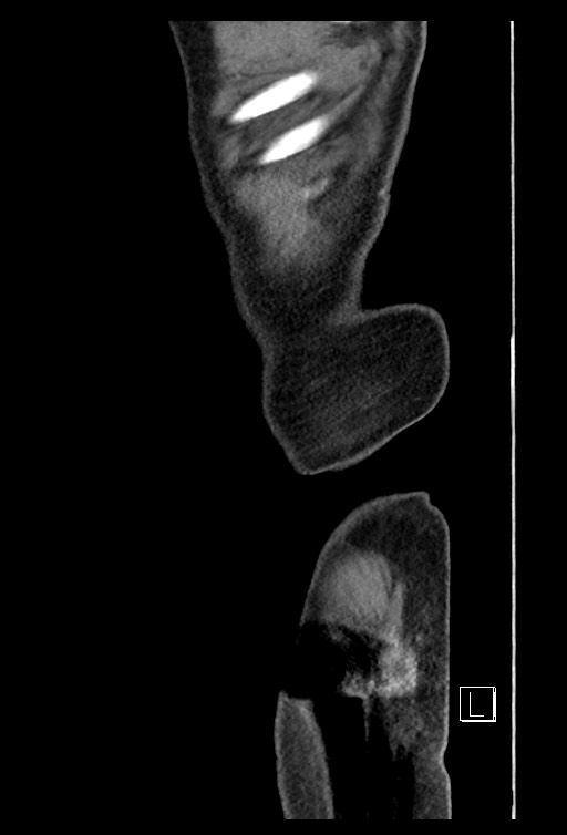 Acute renal infarction - rim capsular enhancement (Radiopaedia 59833-67270 Sagittal C+ portal venous phase 6).jpg