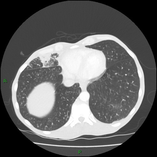 Acute right lung abscess (Radiopaedia 34806-36258 Axial lung window 148).jpg