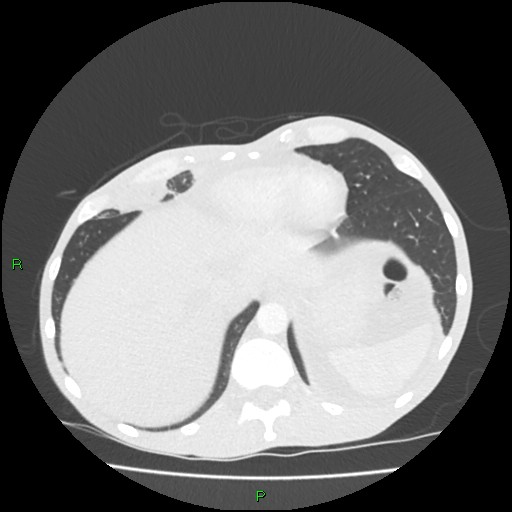 File:Acute right lung abscess (Radiopaedia 34806-36258 Axial lung window 160).jpg