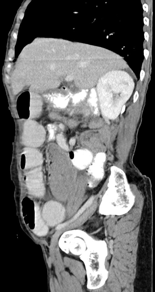 Acute small bowel (ileal) volvulus (Radiopaedia 71740-82139 Sagittal C+ portal venous phase 113).jpg