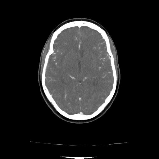 Acute subarachnoid hemorrhage and accessory anterior cerebral artery (Radiopaedia 69231-79009 Axial C+ arterial phase 96).jpg