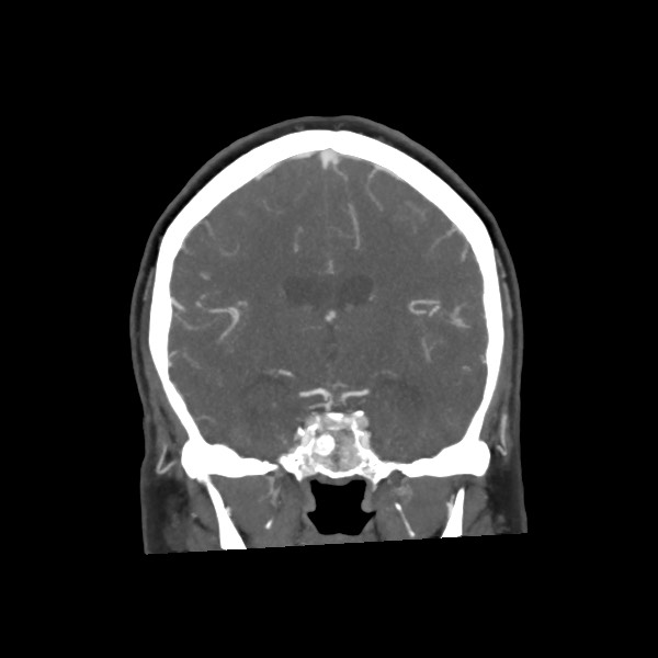 Acute subarachnoid hemorrhage and accessory anterior cerebral artery (Radiopaedia 69231-79009 Coronal C+ arterial phase 43).jpg