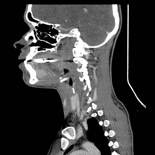 File:Acute submandibular sialadenitis secondary to ductal stone (Radiopaedia 27999-28267 Sagittal C+ delayed 28).jpg