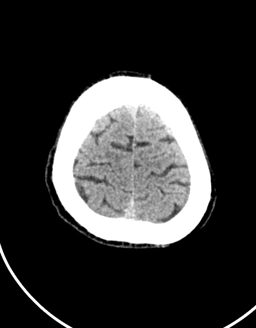Acute superior cerebellar artery territory infarct (Radiopaedia 84104-99359 Axial non-contrast 14).jpg