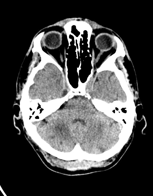 Acute superior cerebellar artery territory infarct (Radiopaedia 84104-99359 Axial non-contrast 50).jpg