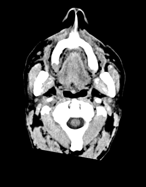 Acute superior cerebellar artery territory infarct (Radiopaedia 84104-99359 Axial non-contrast 72).jpg