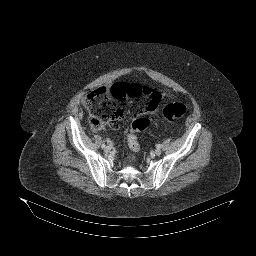 Acute superior mesenteric artery occlusion (Radiopaedia 51288-56960 Axial C+ portal venous phase 80).jpg