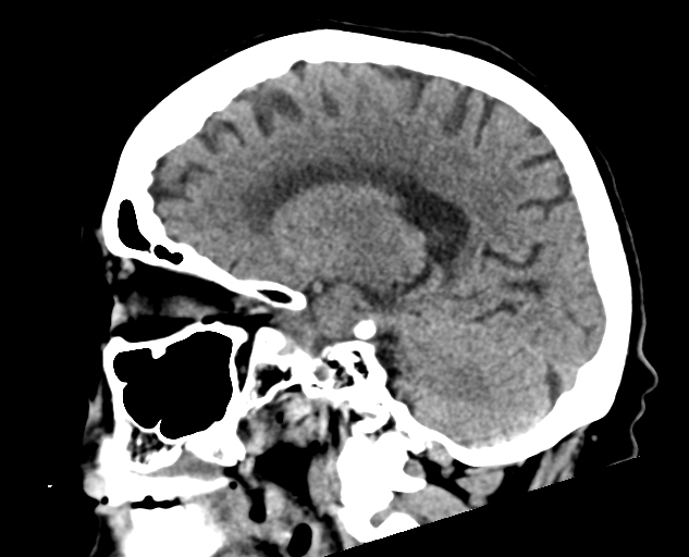 Acute traumatic subdural hematoma (Radiopaedia 82921-97257 Sagittal non-contrast 46).jpg