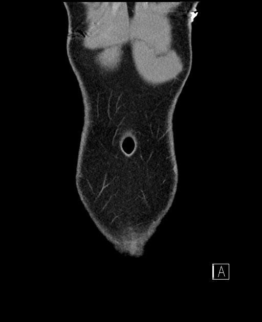 Acute uncomplicated appendicitis (Radiopaedia 61374-69304 Coronal C+ portal venous phase 9).jpg