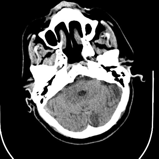 Acute vertebrobasilar ischemic infarction (Radiopaedia 25220-25473 Axial non-contrast 15).jpg