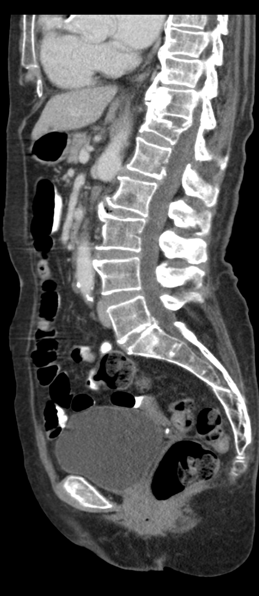 Adenocarcinoma of cecum (Radiopaedia 59222-66549 Sagittal C+ portal venous phase 46).jpg