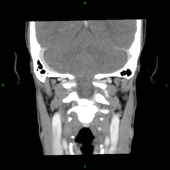 File:Adenoid cystic carcinoma of hard palate (Radiopaedia 26137-26273 Coronal liver window 29).jpg