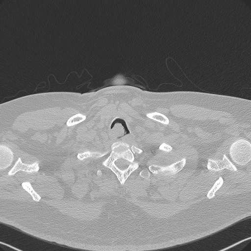 Adenoid cystic carcinoma of the trachea (Radiopaedia 49042-54137 Axial lung window 17).jpg