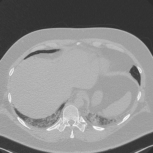 Adenoid cystic carcinoma of the trachea (Radiopaedia 49042-54137 Axial lung window 290).jpg