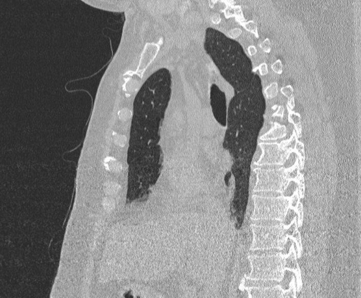Adenoid cystic carcinoma of the trachea (Radiopaedia 49042-54137 Sagittal lung window 213).jpg