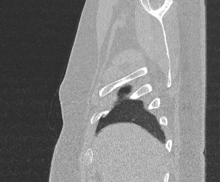Adenoid cystic carcinoma of the trachea (Radiopaedia 49042-54137 Sagittal lung window 48).jpg