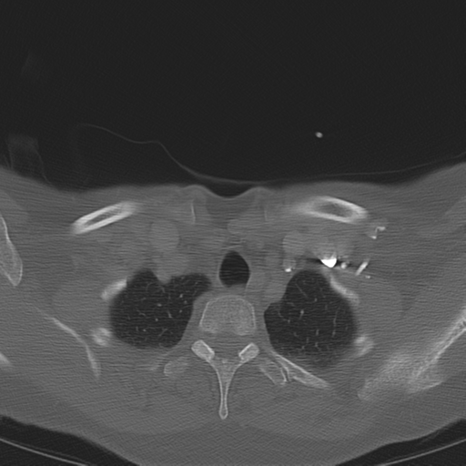 Adenoid cystic tumor of palate (Radiopaedia 46980-51518 Axial bone window 69).png