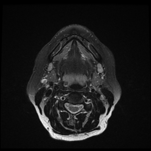File:Adenoid cystic tumor of palate (Radiopaedia 46980-51519 Axial T2 fat sat 12).png