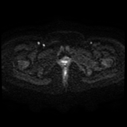 File:Adenoma malignum of cervix (Radiopaedia 66441-75705 Axial DWI 73).jpg