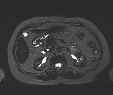 File:Adenomyomatosis of the gallbladder (Radiopaedia 50246-55587 Axial 32).png