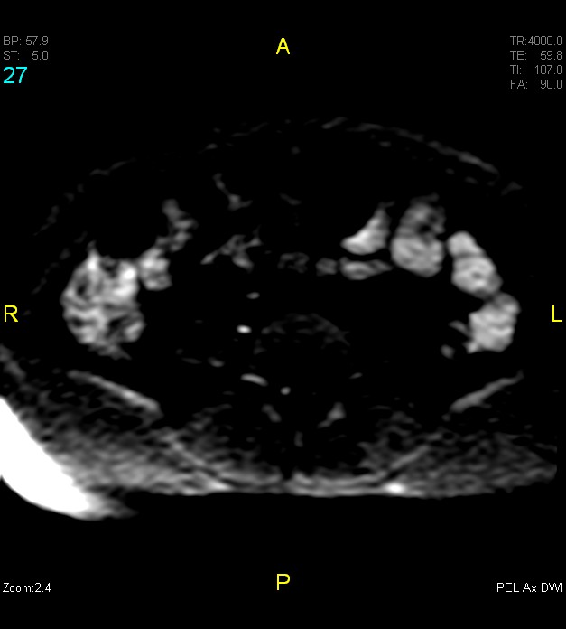 Adenomyosis (Radiopaedia 43504-46889 Axial DWI 27).jpg