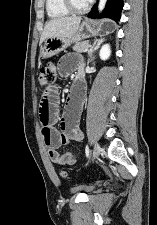 Adhesional small bowel obstruction (Radiopaedia 58900-66131 Sagittal C+ portal venous phase 151).jpg