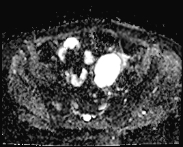 File:Adnexal multilocular cyst (O-RADS US 3. O-RADS MRI 3) (Radiopaedia 87426-103754 Axial 167).jpeg