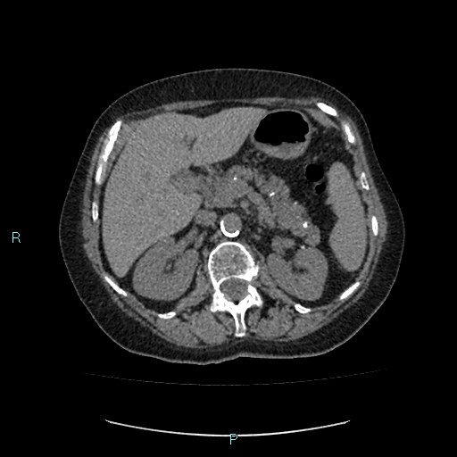 File:Adrenal collision tumor (ACT) (Radiopaedia 48462-53379 Axial non-contrast 18).jpg