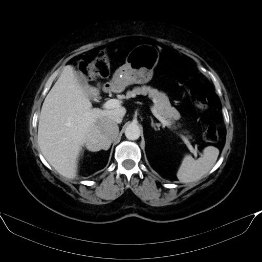 Adrenal cortical carcinoma (Radiopaedia 64017-72769 Axial C+ portal venous phase 19).jpg