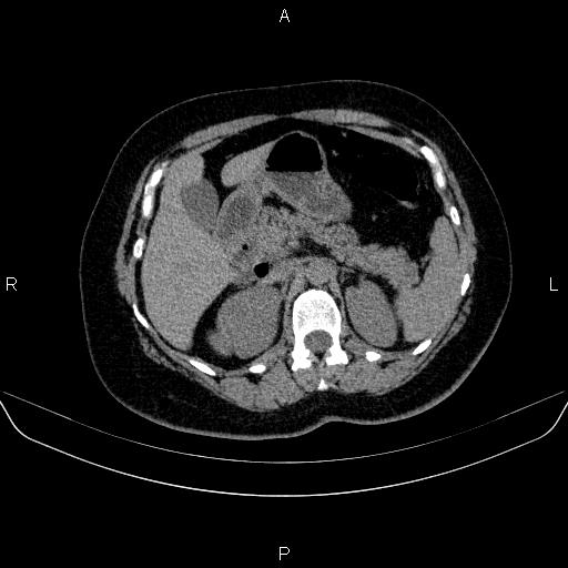File:Adrenal cortical carcinoma (Radiopaedia 84882-100379 Axial non-contrast 29).jpg
