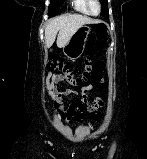 Adrenal cortical carcinoma (Radiopaedia 84882-100379 Coronal C+ portal venous phase 11).jpg