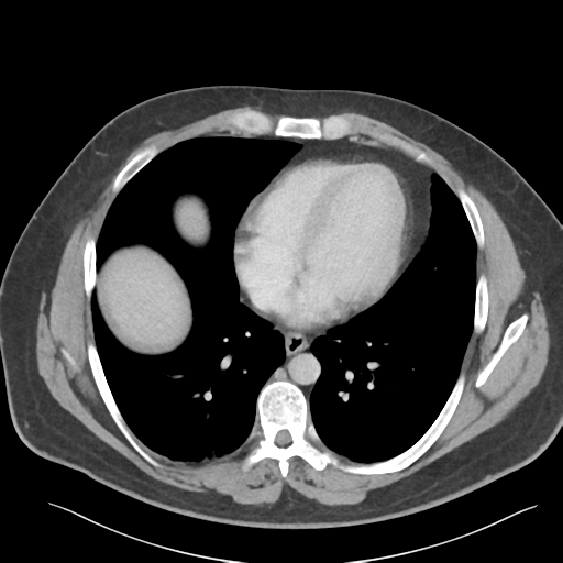 File:Adrenal cyst (Radiopaedia 45625-49777 Axial C+ portal venous phase 9).png