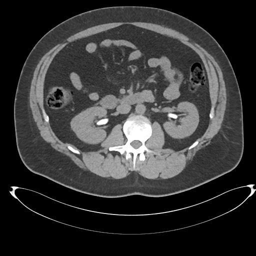 Adrenal cyst (Radiopaedia 45625-49778 Axial non-contrast 52).png