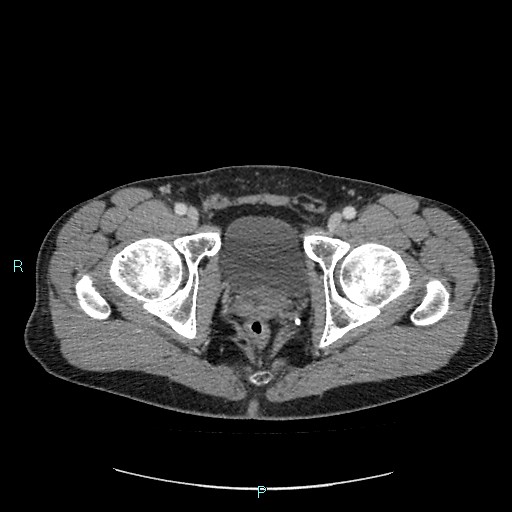 Adrenal cystic lymphangioma (Radiopaedia 83161-97534 Axial C+ portal venous phase 96).jpg