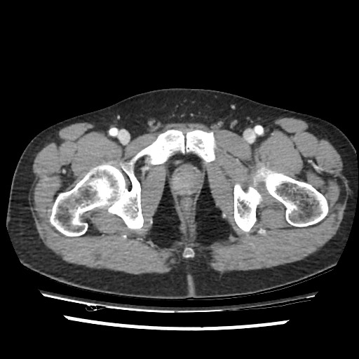 Adrenal gland trauma (Radiopaedia 81351-95078 Axial Dual bolus trauma C+ 121).jpg
