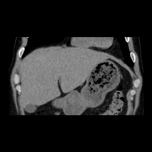 Adrenal gland trauma (Radiopaedia 81351-95079 Coronal non-contrast 24).jpg