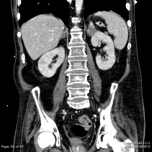 File:Adrenal metastasis (Radiopaedia 78425-91079 Sagittal C+ portal venous phase 43).jpg