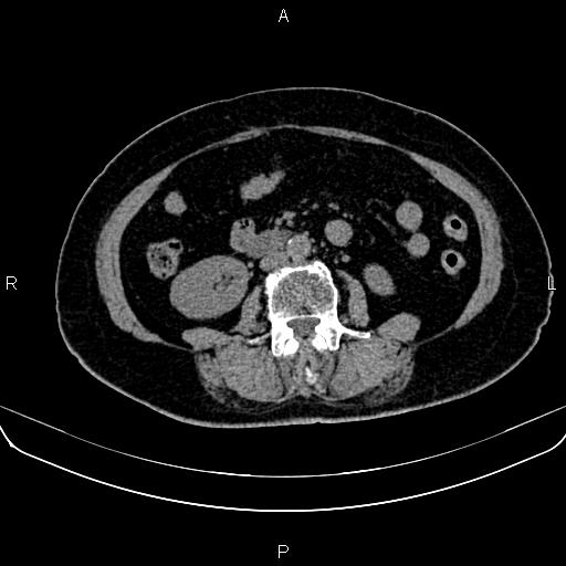 Adrenal myelolipoma (Radiopaedia 82742-96986 Axial non-contrast 85).jpg